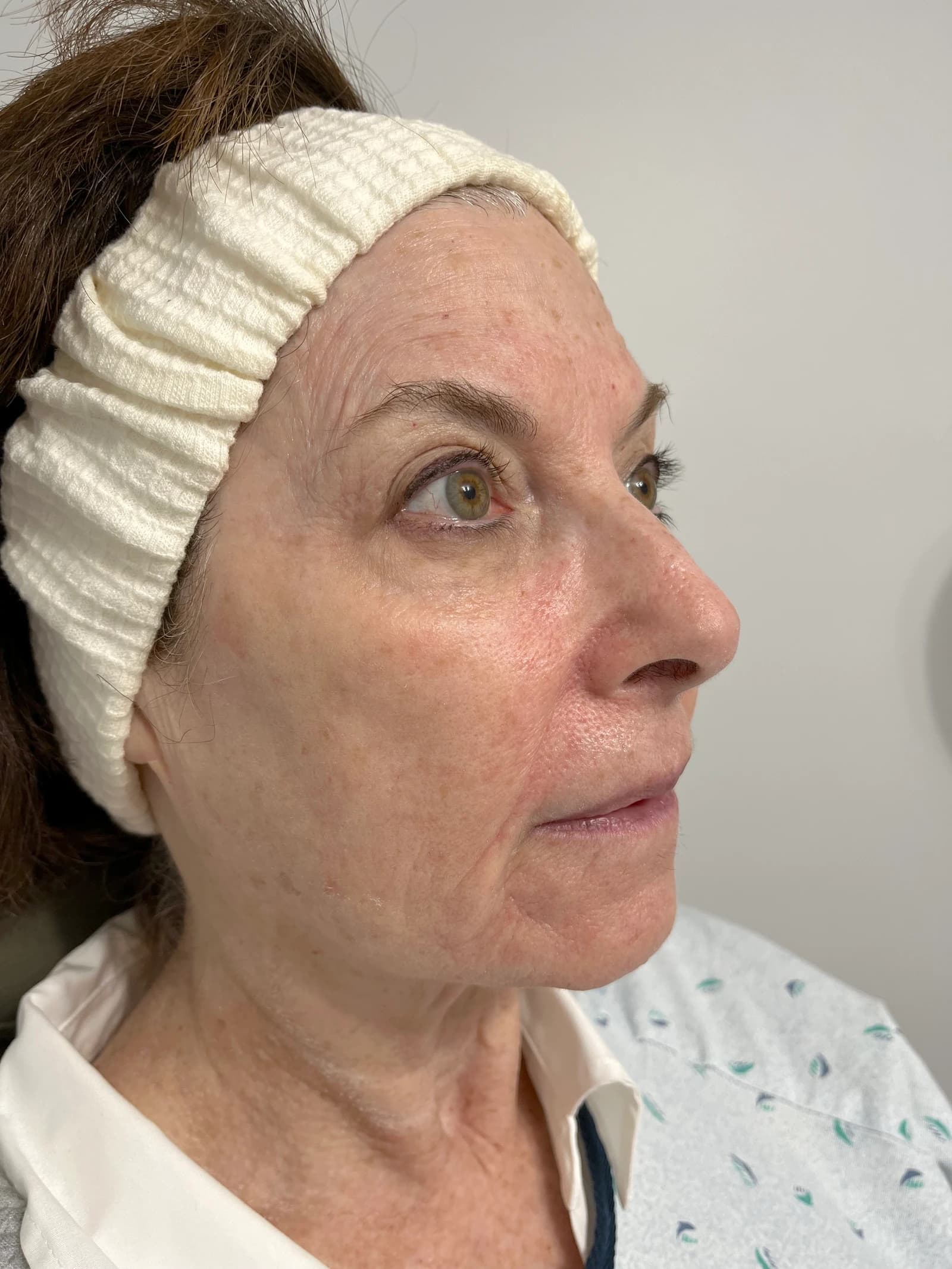 After oxygen infusion facial treatment