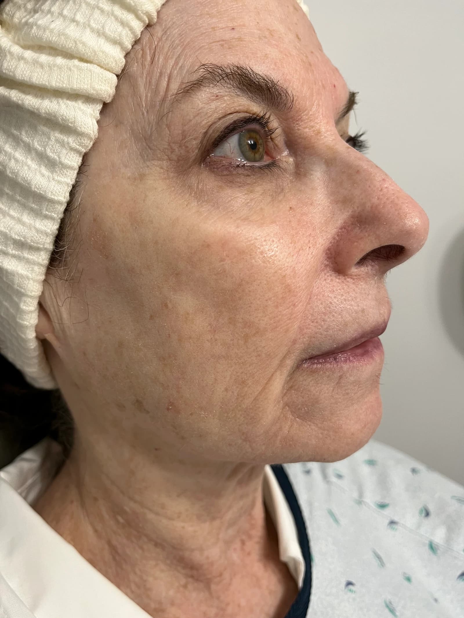 Before oxygen infusion facial treatment